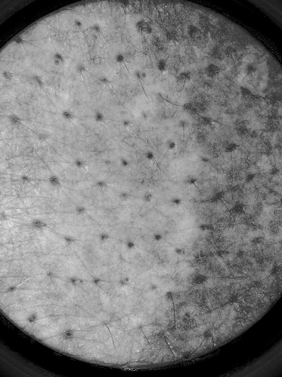 尋常性白斑のUV画像：白斑部分はメラニンが少ないため白く見えます